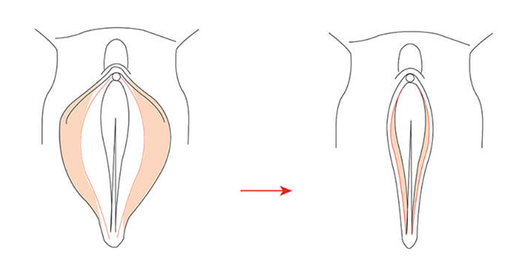 Genital Labiaplasty (Size of Labia Minora)
