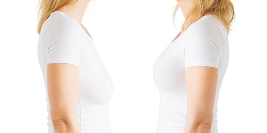 Breast Lifting With Implantation